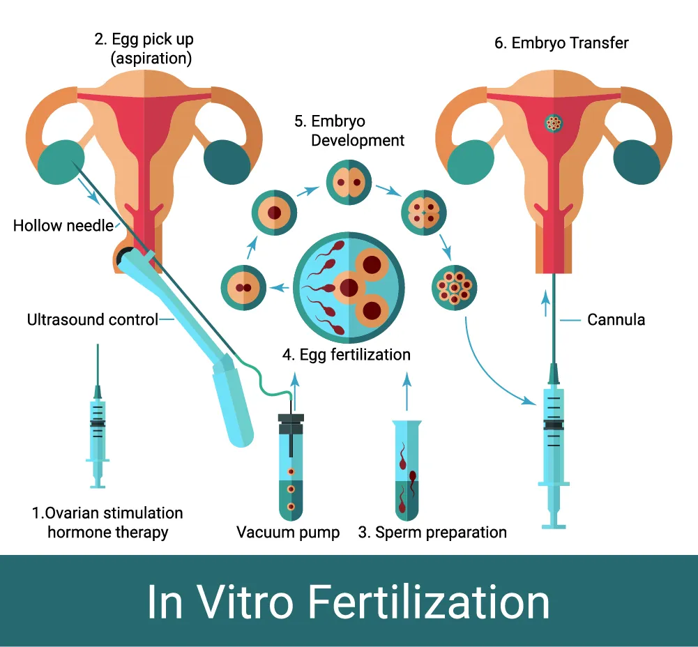 A visual step-by-step guide showing the IVF egg retrieval process using different needle sizes A visual step-by-step guide showing the IVF egg retrieval process using different needle sizes